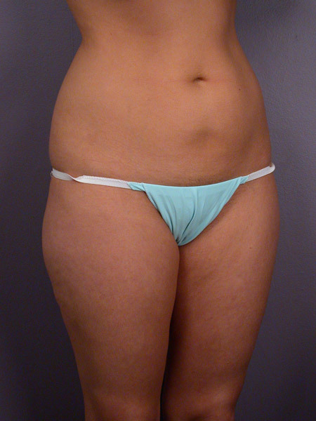 Liposuction before and after photo