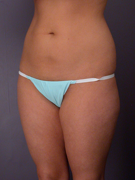 Liposuction before and after photo