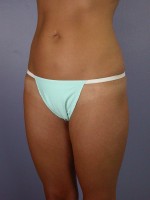 Liposuction Before and after photo