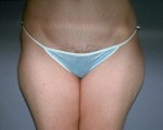 Liposuction