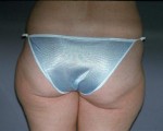 Liposuction