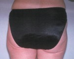 Liposuction