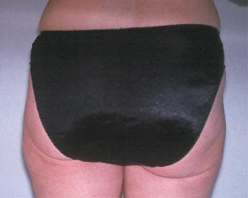Liposuction before and after photo
