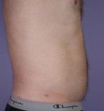 Liposuction Before and after photo