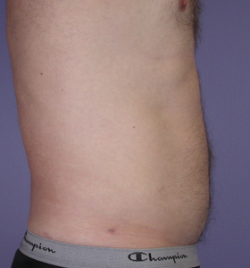 Liposuction before and after photo