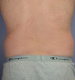 Liposuction Before and after photo