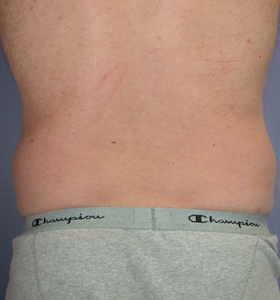 Liposuction before and after photo