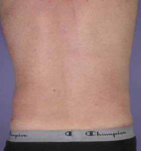 Liposuction before and after photo