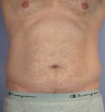 Liposuction