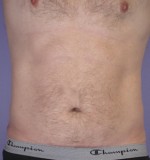 Liposuction