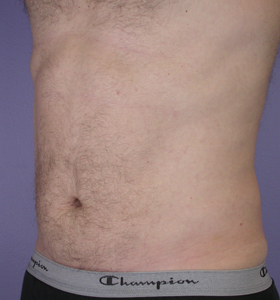 Liposuction before and after photo