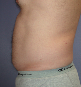 Liposuction before and after photo