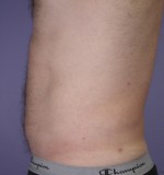 Liposuction Before and after photo