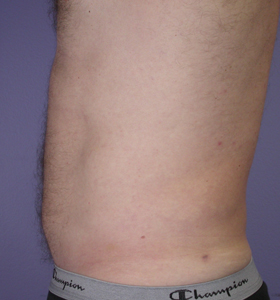 Liposuction before and after photo