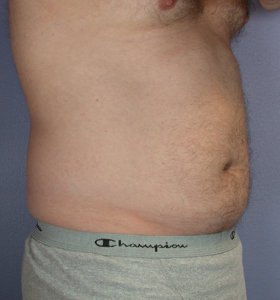 Liposuction before and after photo