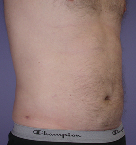 Liposuction before and after photo