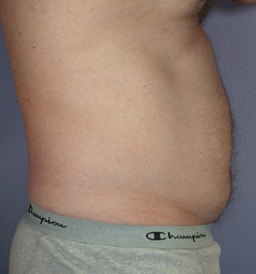 Liposuction before and after photo