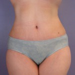 Liposuction Before and after photo