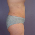 Liposuction Before and after photo