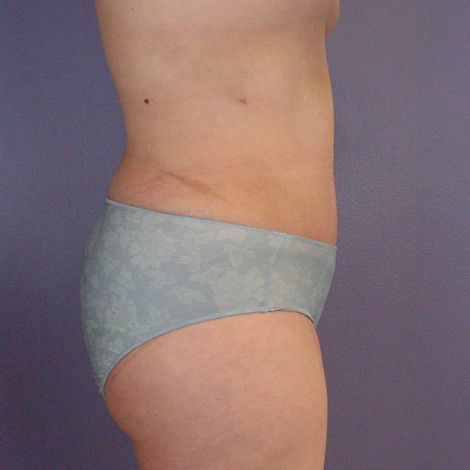 Liposuction before and after photo