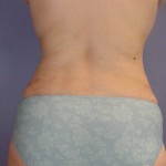 Liposuction Before and after photo