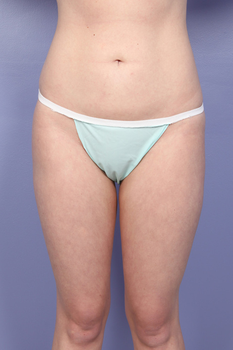 Liposuction before and after photo