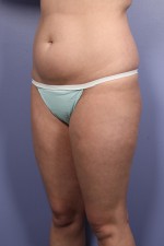 Liposuction Before and after photo