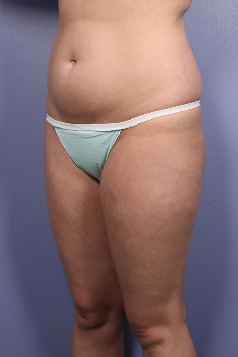 Liposuction before and after photo