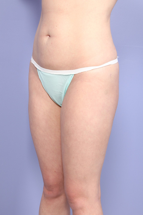 Liposuction before and after photo