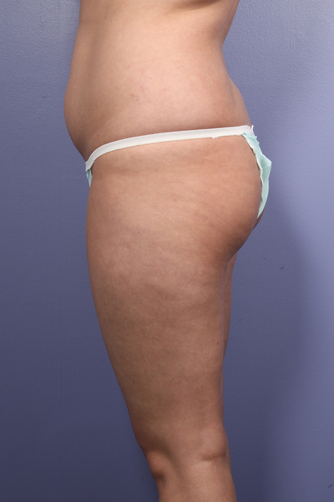 Liposuction before and after photo