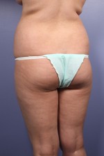 Liposuction Before and after photo