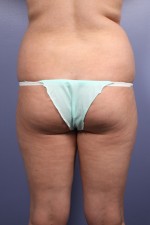 Liposuction