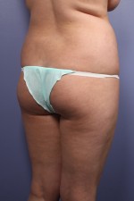 Liposuction