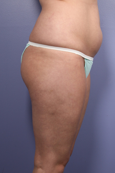 Liposuction before and after photo