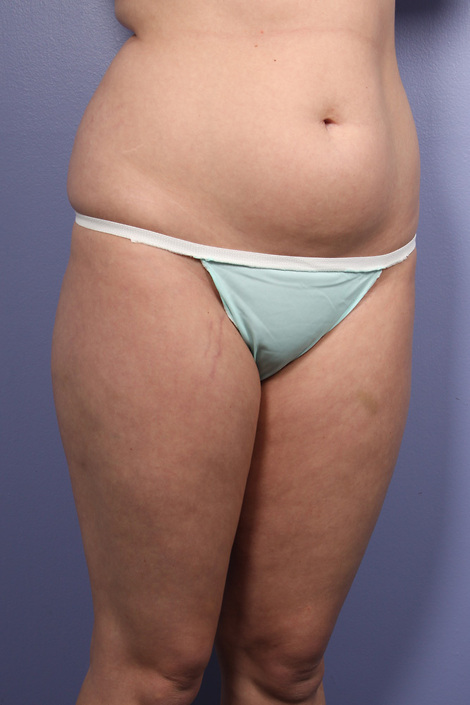 Liposuction before and after photo