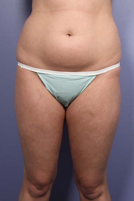 Liposuction before and after photo