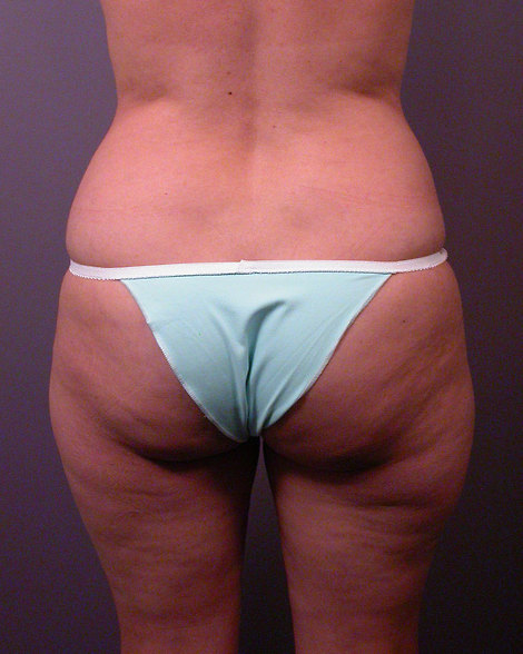 Liposuction before and after photo