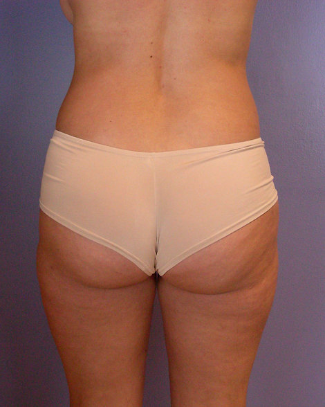 Liposuction before and after photo
