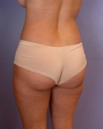 Liposuction Before and after photo