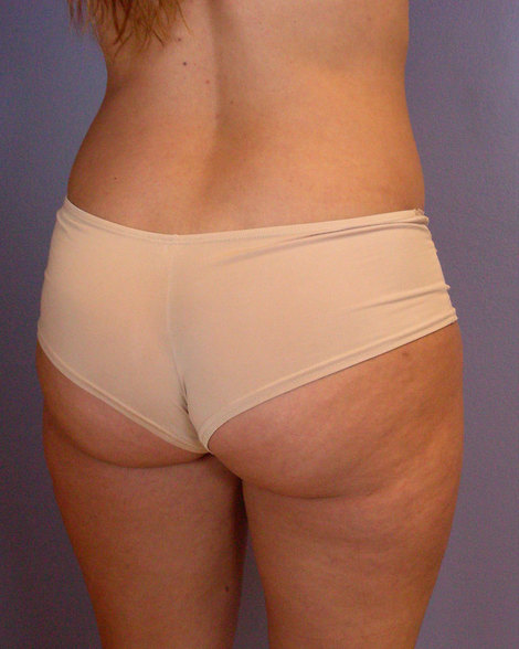Liposuction before and after photo