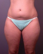 Liposuction