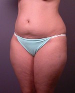 Liposuction
