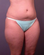 Liposuction Before and after photo