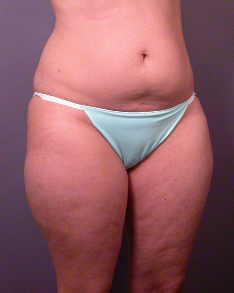 Liposuction before and after photo