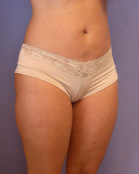 Liposuction before and after photo