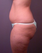 Liposuction Before and after photo