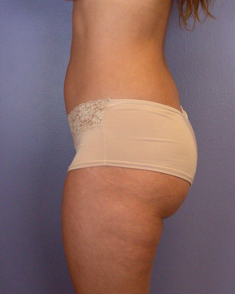 Liposuction before and after photo