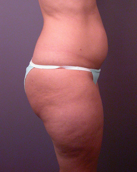 Liposuction before and after photo