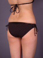 Liposuction Before and after photo