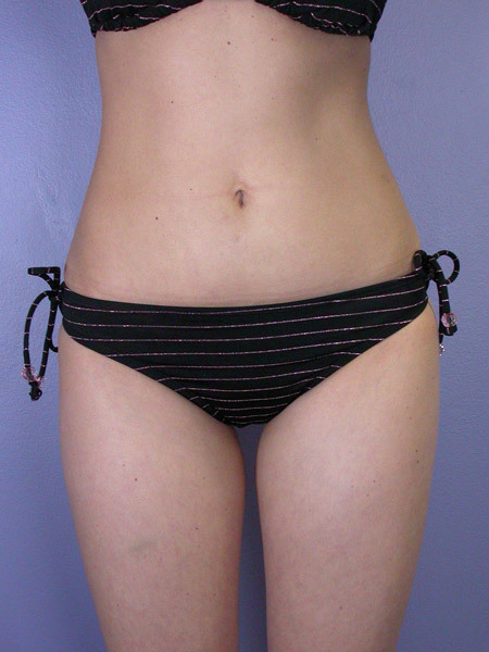 Liposuction before and after photo